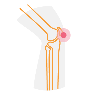 Debiopharm-Trial-Bone and joint infection
