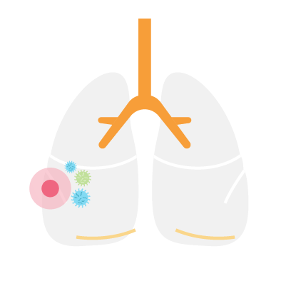 Small-Cell-Lung-cancer-trial